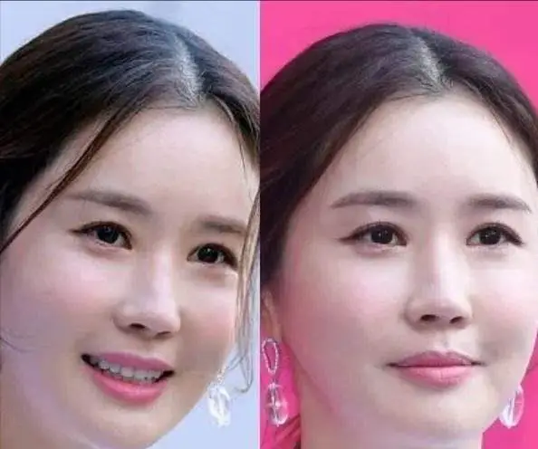 崔智友蔡琳李多海颜值变化_童年韩剧女主整容后遗症_韩剧整容女明星